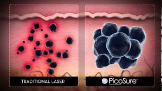 Laser Tattoo Removal  Cynosure Picosure [upl. by Elrae656]