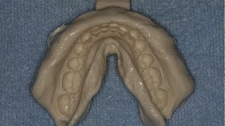 Accurate and Easy Alginate Impressions and Stone Casts [upl. by Hajidahk39]