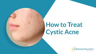 How to Treat Cystic Acne [upl. by Neik]