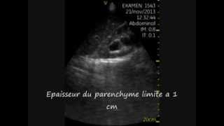 Hydronephrose severe Echographie de poche aux urgences [upl. by Georgine770]