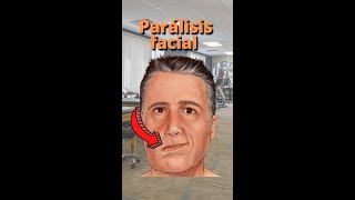 Qué ejercicios hacer en la Parálisis facial [upl. by Eladnor564]