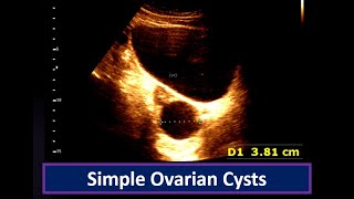 Understanding Simple Ovarian Cysts Ultrasound Findings  Ovarian Cyst  Simple follicular cyst [upl. by Ranilopa]