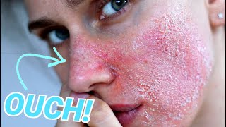 How to Tell if Your Skin Barrier is Damaged [upl. by Adyela]