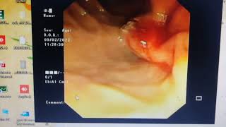 Precut sphincterotomy made easy Malignant EHBO ERCP [upl. by Cleti]