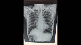 Peritonitis  pneumoperitoneum  chest x ray srivarihospital [upl. by Madai]