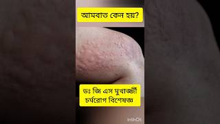 Allergy Urticaria Itching Skin rash Dr G S Mukherjee dermatologist allergy skinspecialist [upl. by Alyce]