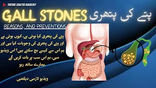 gallstones Unveiled Understanding Causes Symptoms and Treatment Options theradiology5817pain [upl. by Lottie223]