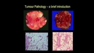 Tumour pathology  a brief introduction part III [upl. by Abas]