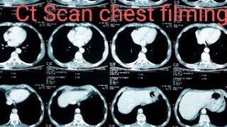 Ct scan chest plain filming  ct chest filming [upl. by Itsrejk635]