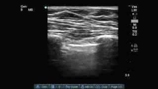 Lung ultrasound quotLung Pointquot [upl. by Asena530]