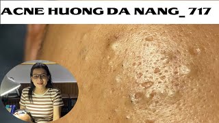 Acne Treatment Huong Da Nang 717  Remove Blackheads [upl. by Piselli286]