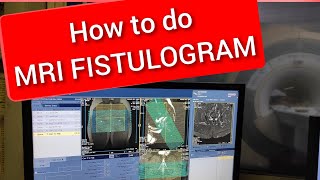 Fistulogram MRI scan protocol positioning and planning [upl. by Pellet]