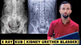 X Ray KUBkidney urether bladder  position  procedure  sir waqar ahmed [upl. by Nev]