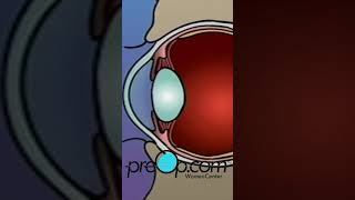 PreOp® 👁️ LASIK Surgery Explained Simply preop shorts health 🌟 [upl. by Ahsat]