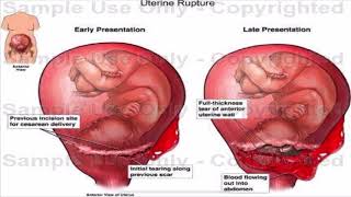 Uterine rupture [upl. by Anewor]