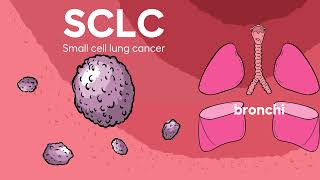 Small Cell Lung Cancer Explained [upl. by Yenettirb]