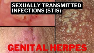 Herpes Simplex Virus Genital Herpes CausesSymptoms diagnosis and Natural Treatment  Fruits [upl. by Temhem]