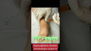 prptherapy topuqağrısı arthrosis [upl. by Minta385]