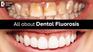 All about Dental Fluorosis  Tooth Discolouration  Tooth Colour Dr Lahari ASR  Doctors Circle [upl. by Asilem]