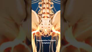 Degenerative Scoliosis Symptoms [upl. by Hurlee784]