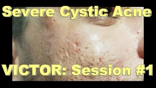 Severe Cystic Acne  Victor Session 1 [upl. by Llenoil]