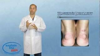 What is Haglunds Deformity or quotPump Bumpquot [upl. by Damara]