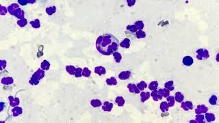 Synovial fluid cytology  inflammatory changes  degenerate neutrophils [upl. by Alyag759]