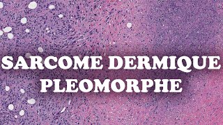 LE SARCOME DERMIQUE PLEOMORPHE – PATHOLOGIE [upl. by Arick]