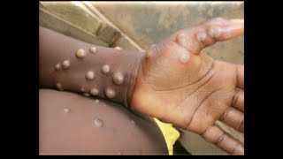 Indwara y Ubushita Bw Inkende MPox Mpox Disease Monkeypox CreditsRBCampMOH RWANDA [upl. by Yelsek463]