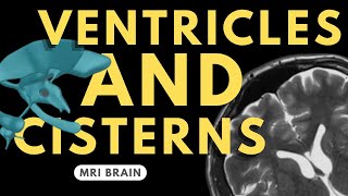 Ventricles and Cisterns of the Brain  Radiology anatomy part 1 prep  MRI brain [upl. by Eugenius]