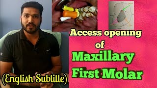 Access opening of maxillary first molar [upl. by Nedda]