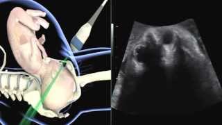 ISUOG how to perform ultrasound in labor assessment of fetal occiput position [upl. by Isadora]