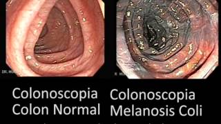 Comparación Colon Normal y Colon con Melanosis Coli [upl. by Osnola462]