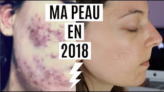 ACNE  Boutons et Cicatrices ✨MA PEAU EN 2018 ✨Update [upl. by Sonia]