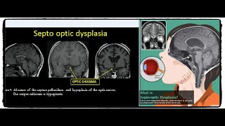 Rare Diseases SeptoOptic Dysplasia [upl. by Mallen]