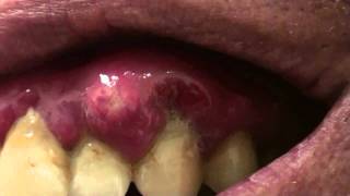 Abscess in mouth [upl. by Woodman]