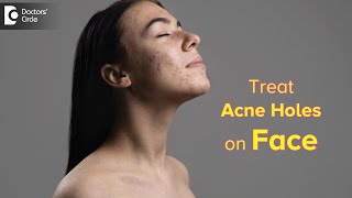 Top Ways to Get Rid of ACNE HOLES  How to fill ACNE HOLES on faceDr Rasya Dixit Doctors Circle [upl. by Shabbir130]