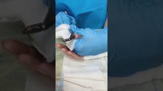 World Biggest BOT FLY Removal From Finger OMG😱 huge bot fly on girl  botfly botflyremoval [upl. by Aimehs]