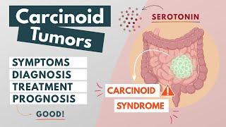 Carcinoid Tumor  Visual Explanation  Symptoms diagnosis treatment prognosis [upl. by Eirod]