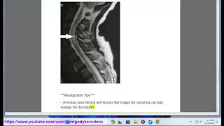 lhermitte sign 101 lhermittes sign differential diagnosis [upl. by Akemeuwkuhc932]