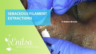 Sebaceous Filament Extractions [upl. by Gunner]