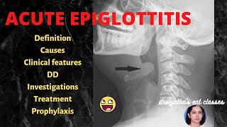 166Acute Epiglottitis  treatment of acute epiglottitis stridor epiglottis [upl. by Nelon]