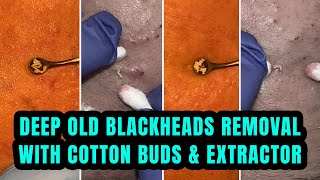 DEEP OLD BLACKHEADS REMOVAL  WITH COTTON BUDS amp EXTRACTOR  NEW VIDEO 2024 [upl. by Ardussi]