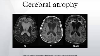 Cerebral atrophy [upl. by Droc]