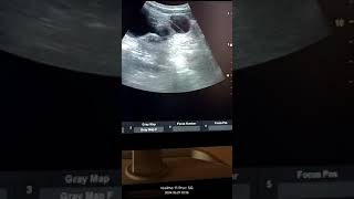 Ovarian Cyst in 30 year female pain in pelvic region Dermoid cyst ovary [upl. by Leschen]