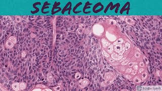 Sebaceoma 5Minute Pathology Pearls [upl. by Nnaj]