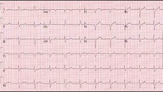 ECG Interpretation Tutorial  ChalkTalk 300 Advanced Level [upl. by Nithsa]