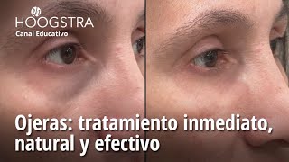 Ojeras tratamiento inmediato natural y efectivo  24130 [upl. by Kenzi732]