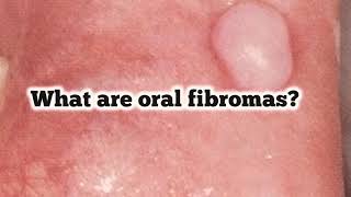 What are oral fibromas Are they benign lesions [upl. by Nie]