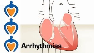 Arrhythmias  What is an arrhythmia and how is it treated [upl. by Deck518]